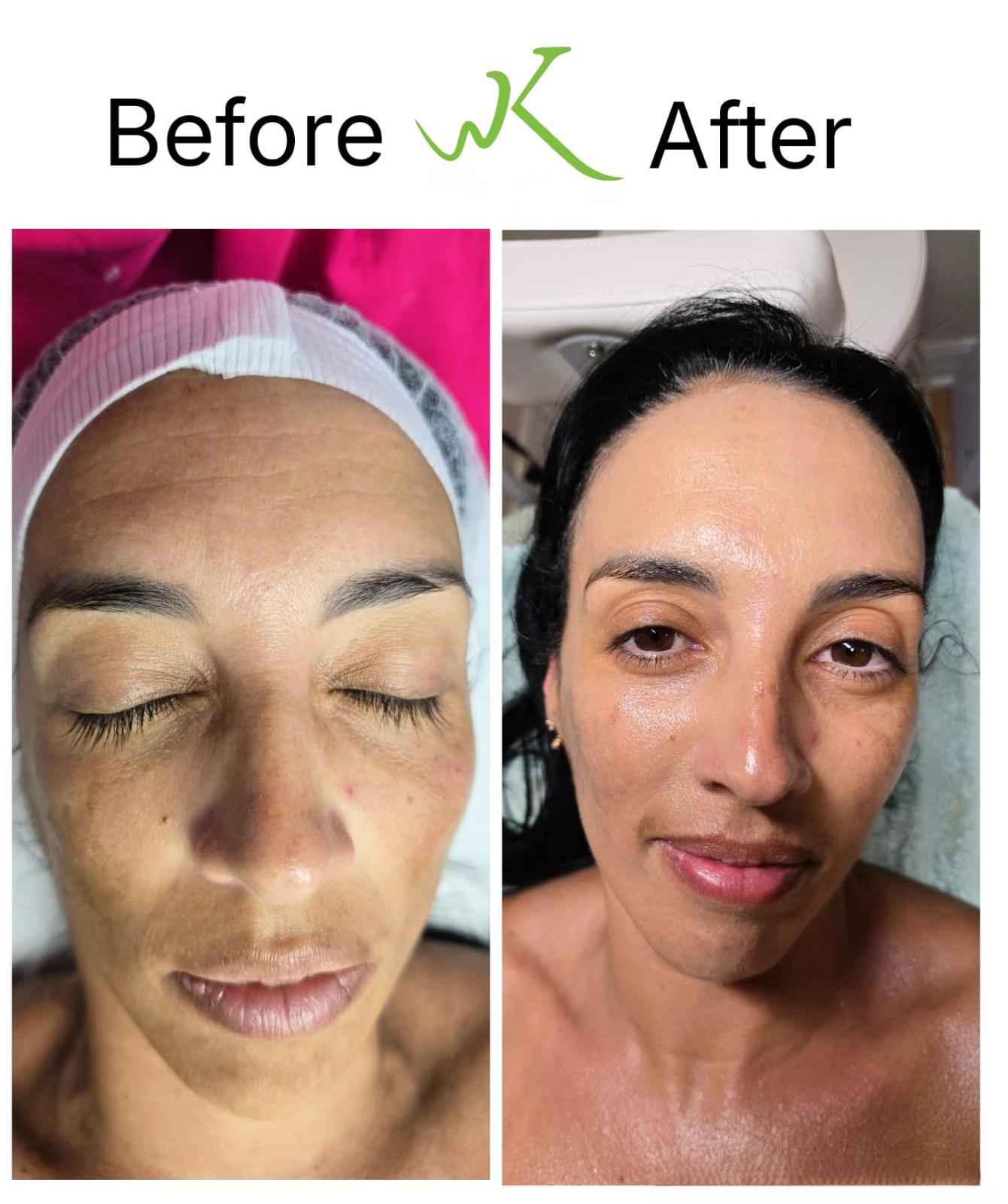 Deep Facial Before and After