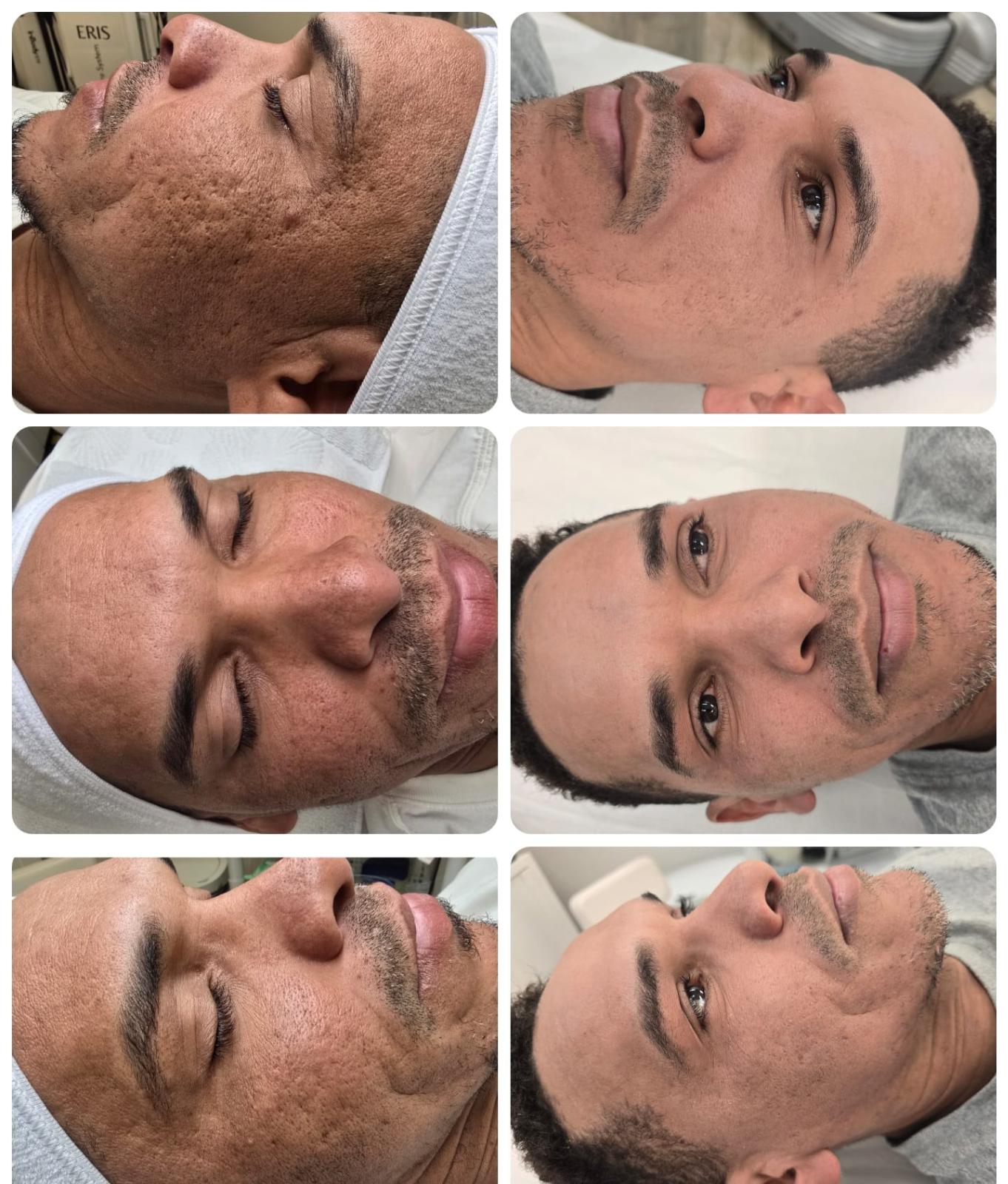 Cosmelan is a professional depigmenting method that fully removes spots and prevents their reappearance for a short- and long-term outcome.