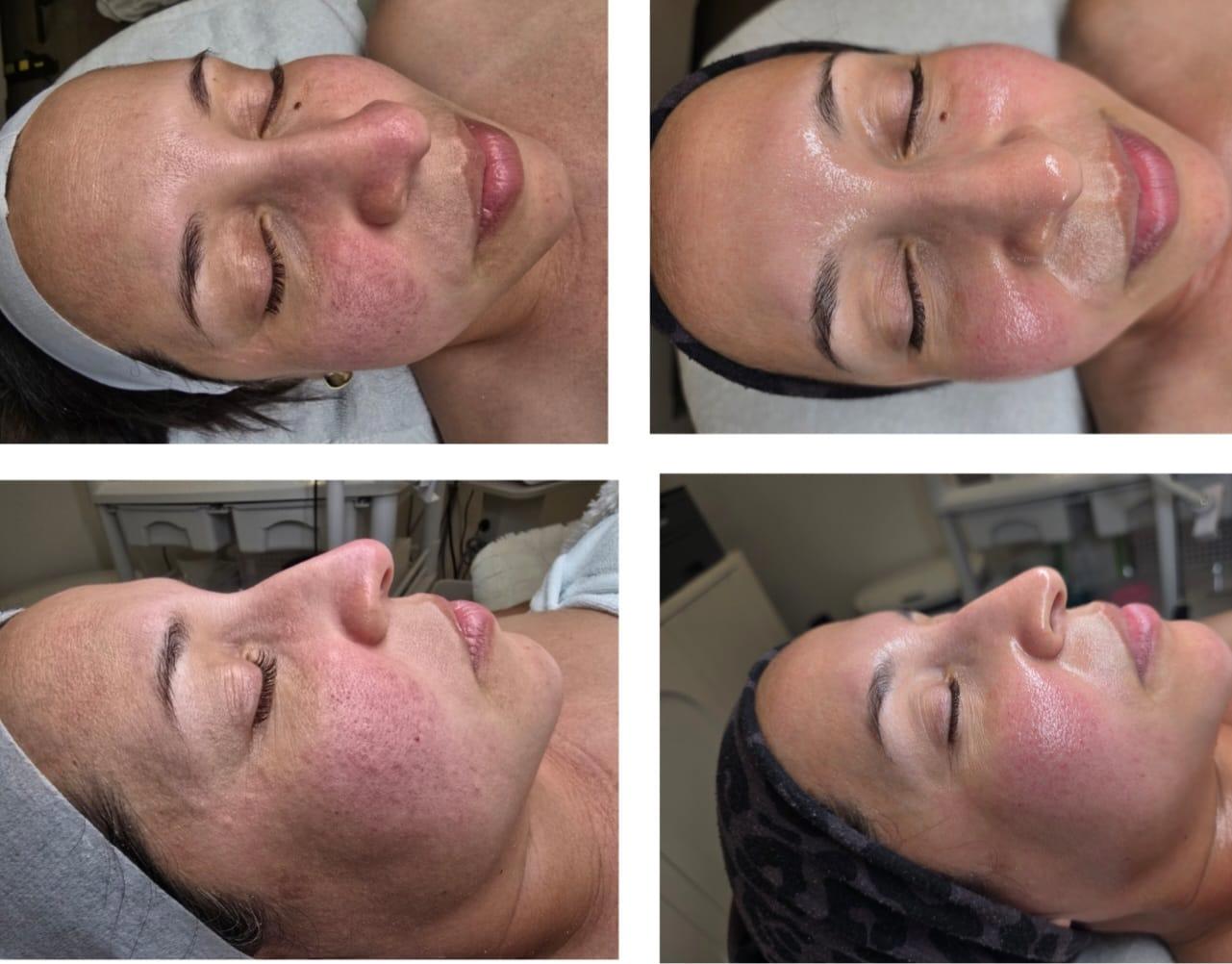 SkinPen® Microneedling + Exosomes at Wellness Key Center®. Results develop progressively and vary by client.